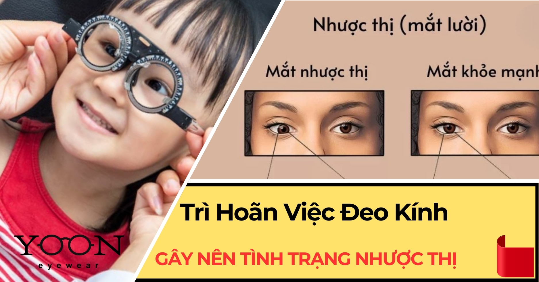Trì Hoãn Đeo Kính Có Thể Gây Nên Tình Trạng Nhược Thị Ở Mắt