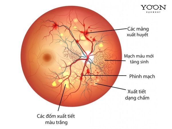 BỆNH ĐÁI THÁO ĐƯỜNG TÁC ĐỘNG LÊN MẮT NHƯ THẾ NÀO?