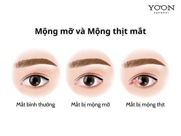 CÁC LOẠI MỘNG MẮT PHỔ BIẾN