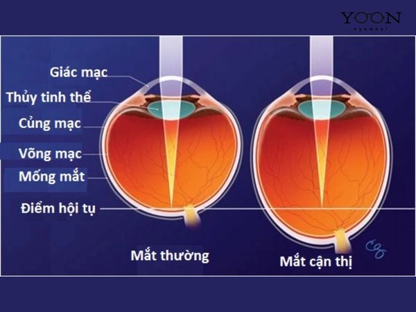 CẬN THỊ ĐƠN LÀ GÌ?