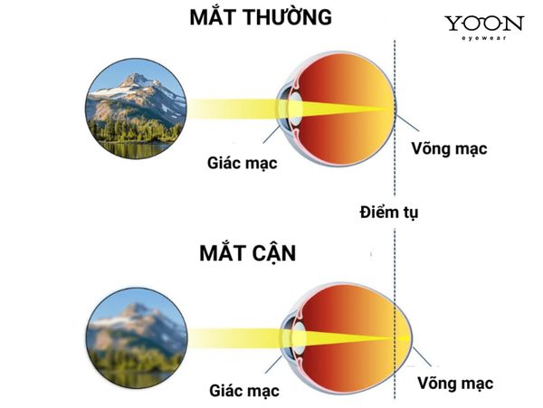 CẬN THỊ LÀ NHƯ THẾ NÀO?