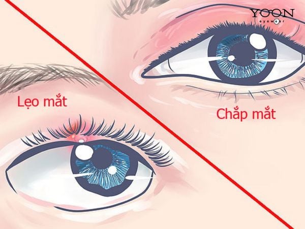 CHẮP MẮT KHÁC VỚI LẸO MẮT NHƯ THẾ NÀO?