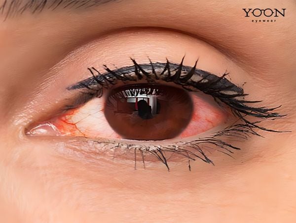 Hủy Hoại Thị Lực