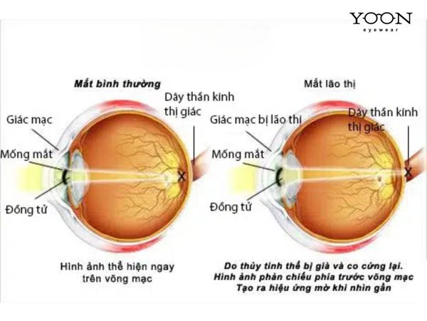 LÃO THỊ LÀ GÌ? NGUYÊN NHÂN GÂY RA LÃO THỊ?