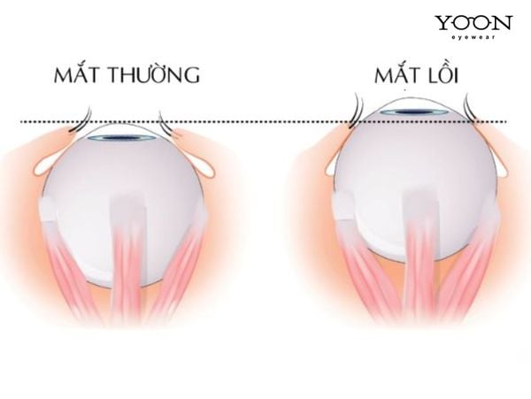 MẮT LỒI LÀ GÌ?