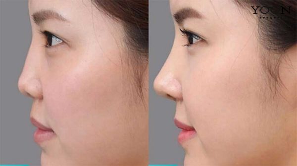 MŨI TẸT LÀ MŨI NHƯ THẾ NÀO?