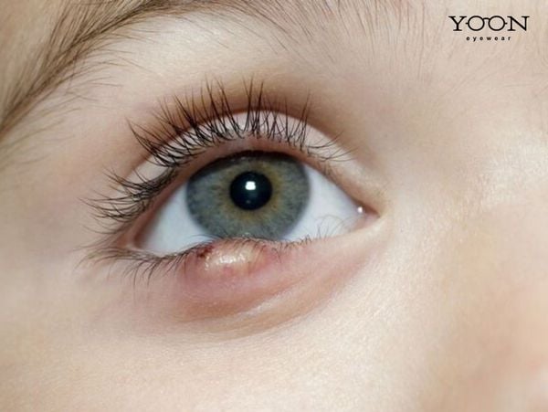 NGUYÊN NHÂN BỊ CHẮP MẮT TỪ ĐÂU?