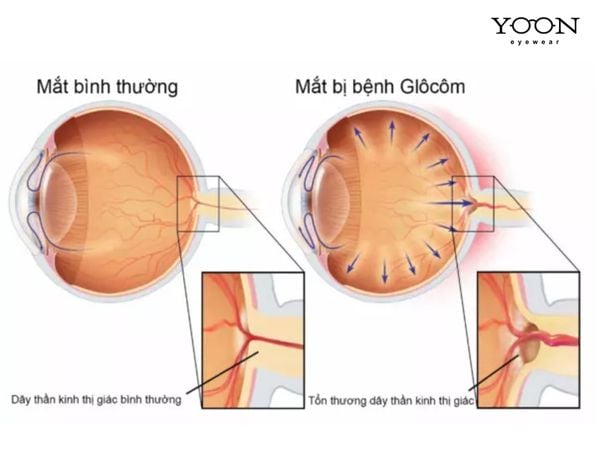 NGUYÊN NHÂN GÂY RA CƯỜM NƯỚC LÀ GÌ?
