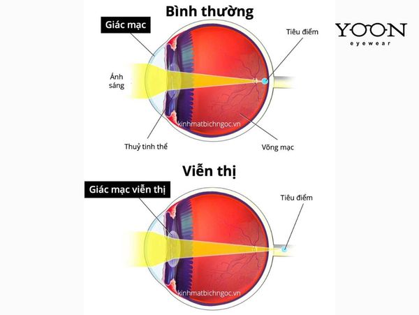 VIỄN THỊ LÀ GÌ? NGUYÊN NHÂN GÂY RA VIỄN THỊ?