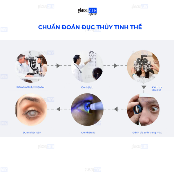 Đục thủy tinh thể