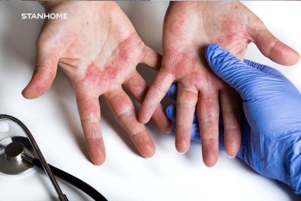 Viêm da cơ địa ở tay: Nguyên nhân và cách điều trị hiệu quả