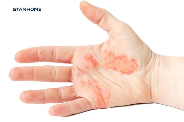 Bệnh chàm tổ đỉa là gì? Triệu chứng và cách chăm sóc tại nhà