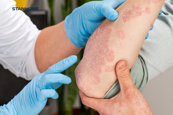 Bệnh vảy nến có chữa được không và cách chung sống hòa bình