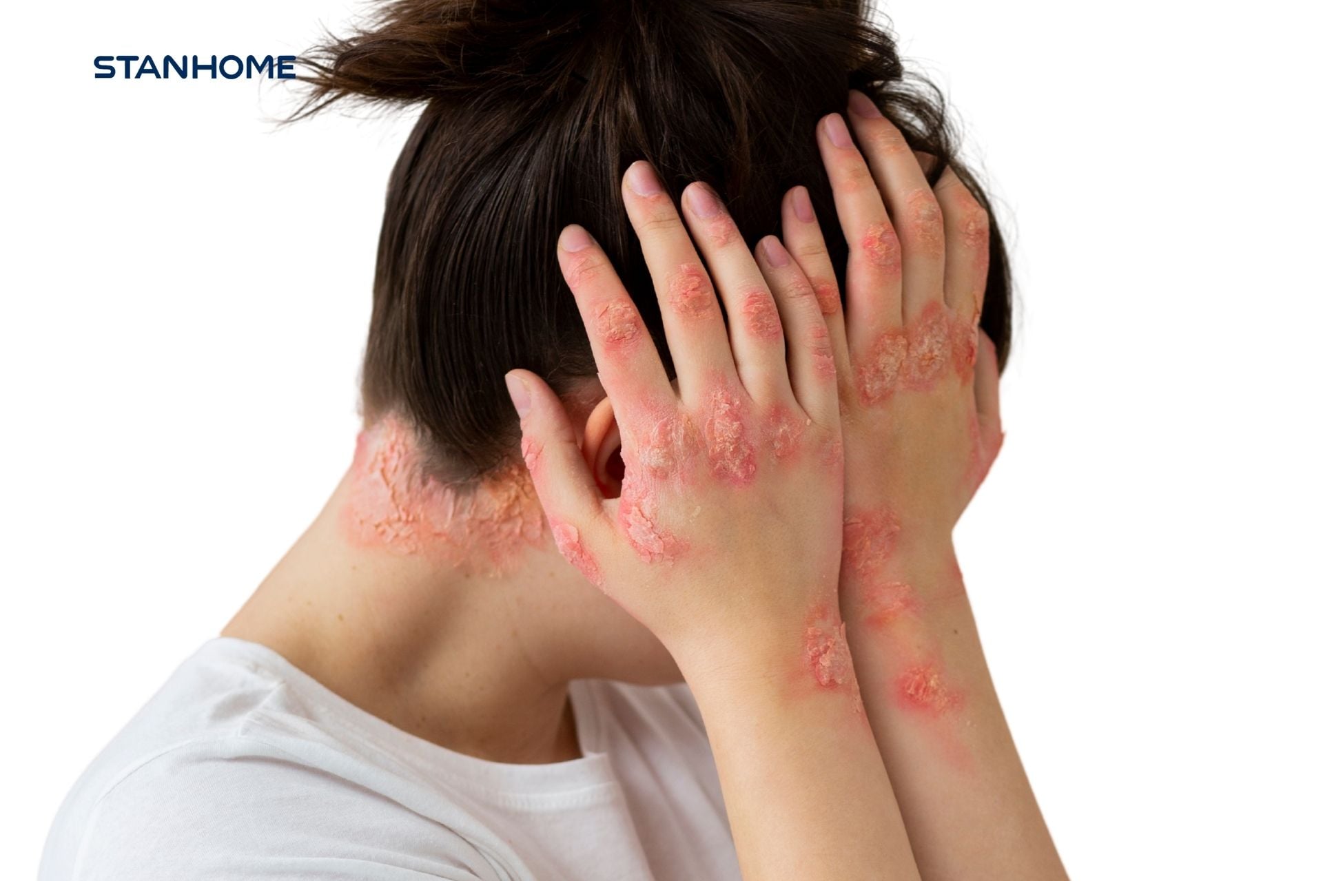 Bệnh vảy nến tái phát liên tục do đâu?