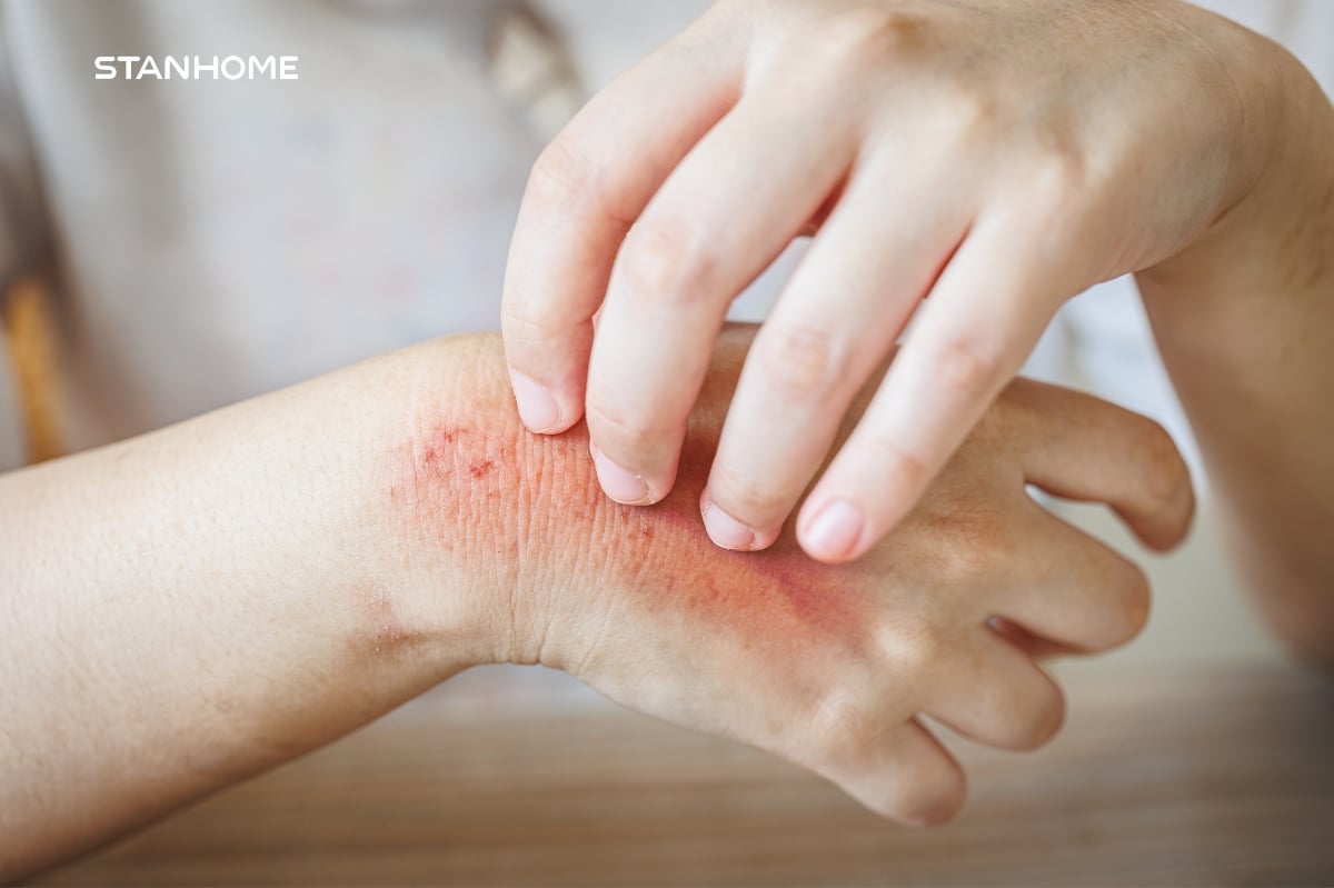 10 cách giảm ngứa khi bị viêm da cơ địa hiệu quả ngay tại nhà