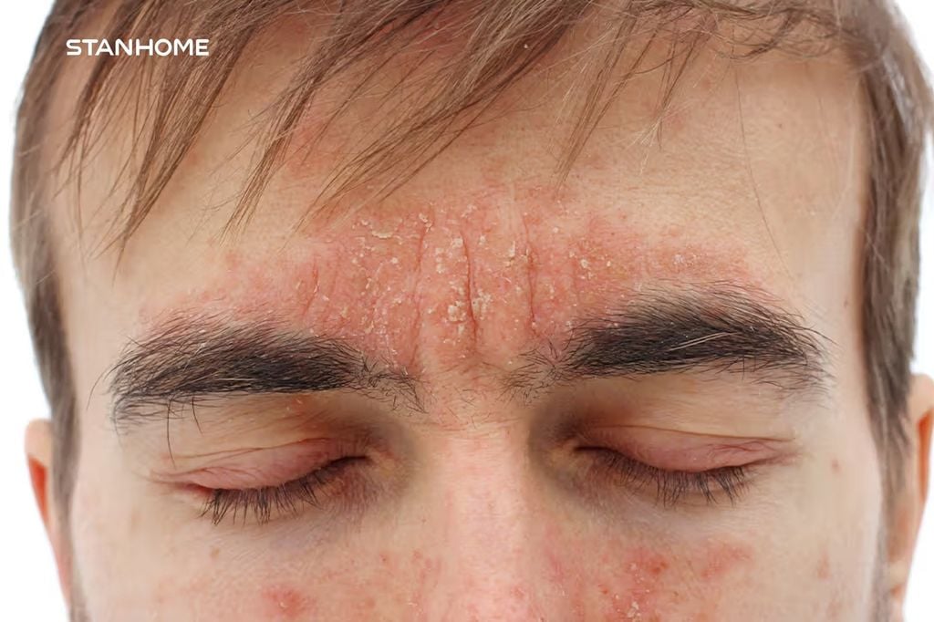 Chăm sóc viêm da tiết bã cần lưu ý gì?