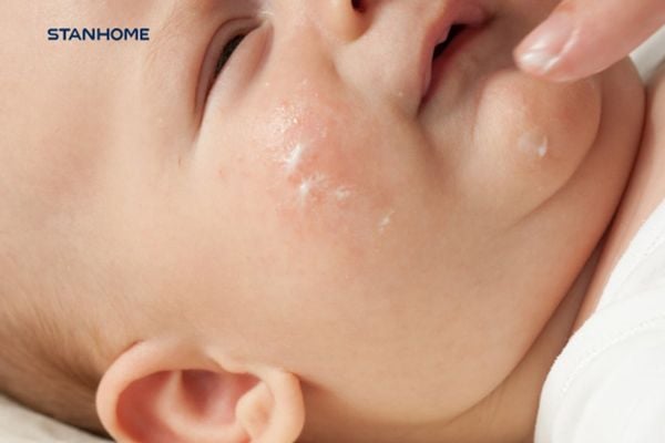 Hiểu đúng và dùng đúng cách Thuốc bôi viêm da cơ địa trẻ em
