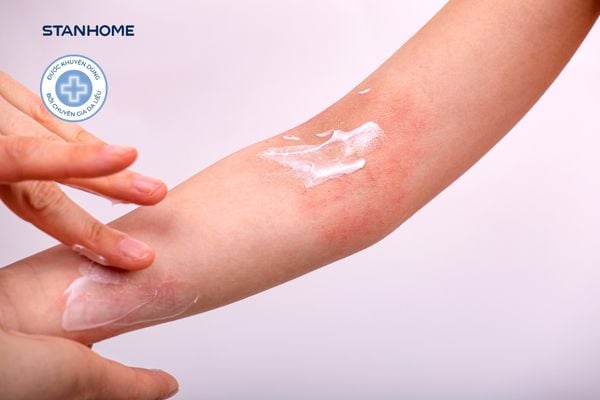 Kem bôi viêm da cơ địa được bác sĩ da liễu khuyên dùng