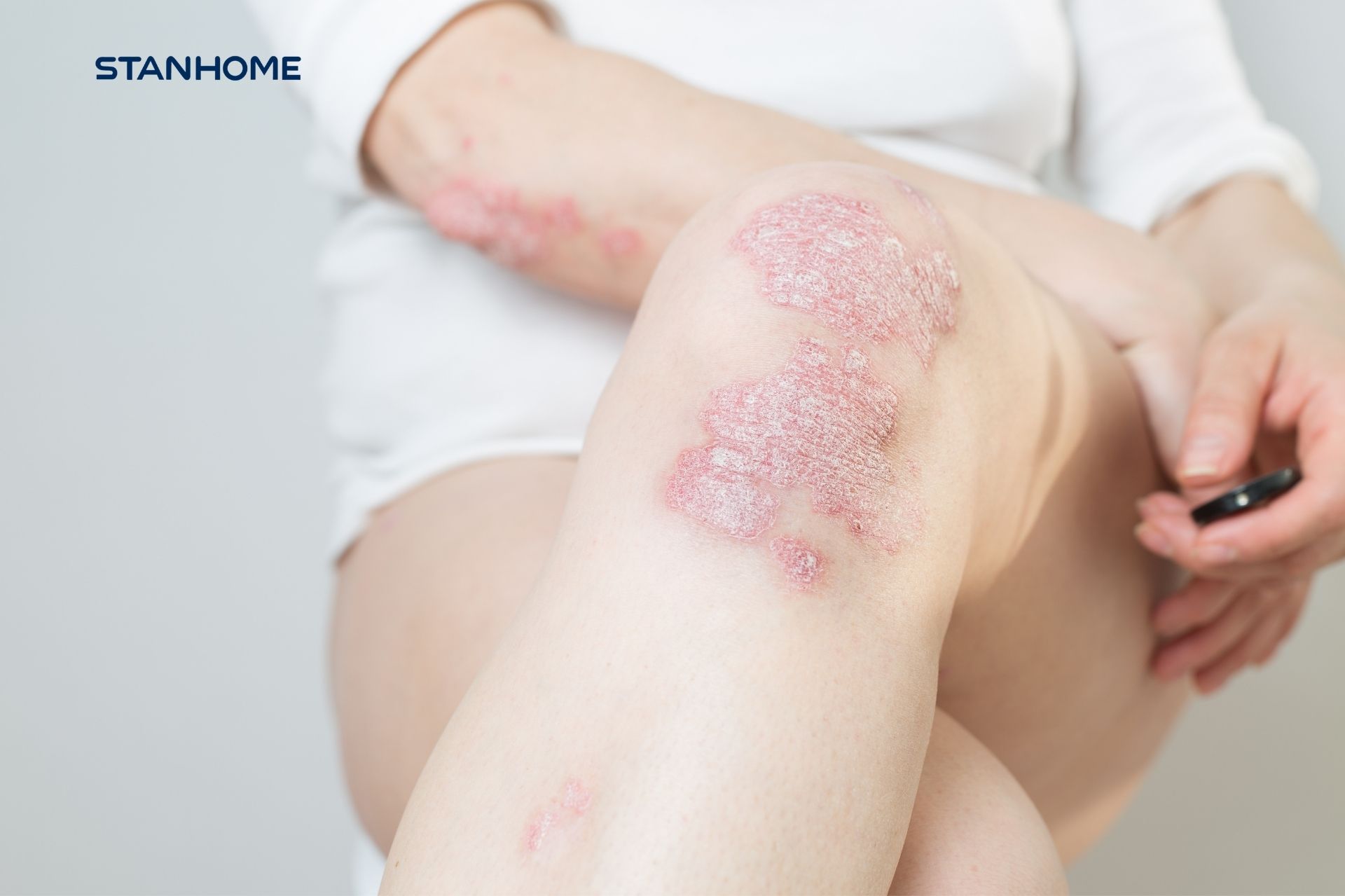 Tất cả những điều bạn cần biết về vảy nến