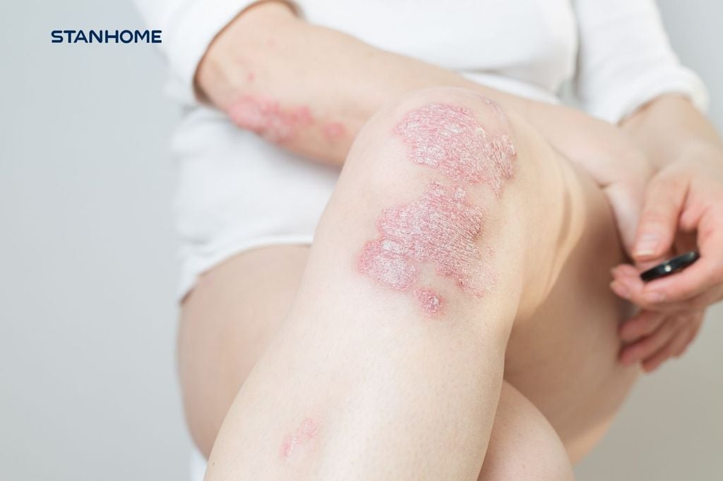 Tất cả những điều bạn cần biết về vảy nến