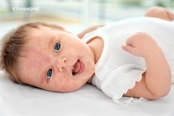 Viêm da cơ địa ở trẻ em: Những điều cha mẹ phải biết để bảo vệ con