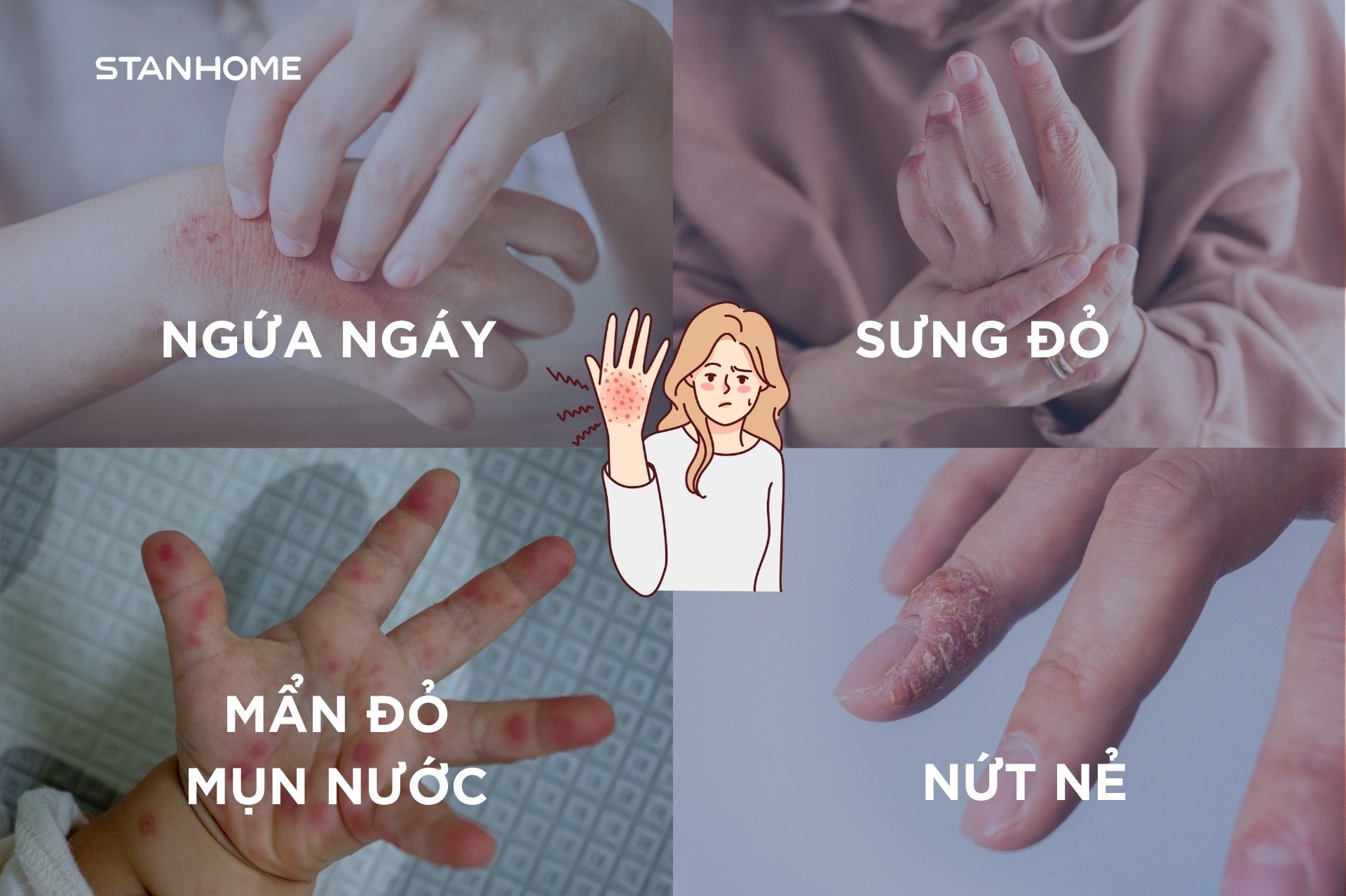 Triệu chứng thường gặp của viêm da cơ địa ở tay là ngứa, sưng, đỏ rát, mẩn đỏ, mụn nước, nứt nẻ có vảy