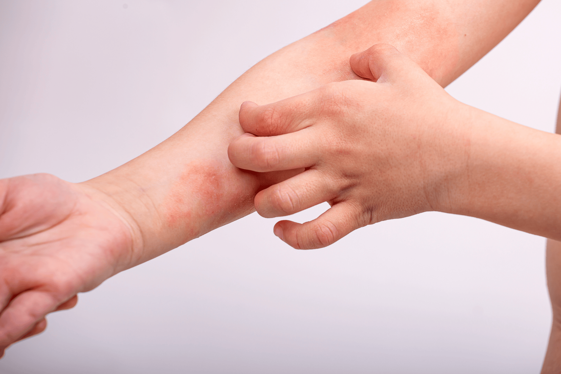Viêm da cơ địa dễ tái phát vào mùa hanh khô khi da không được chăm sóc đúng cách