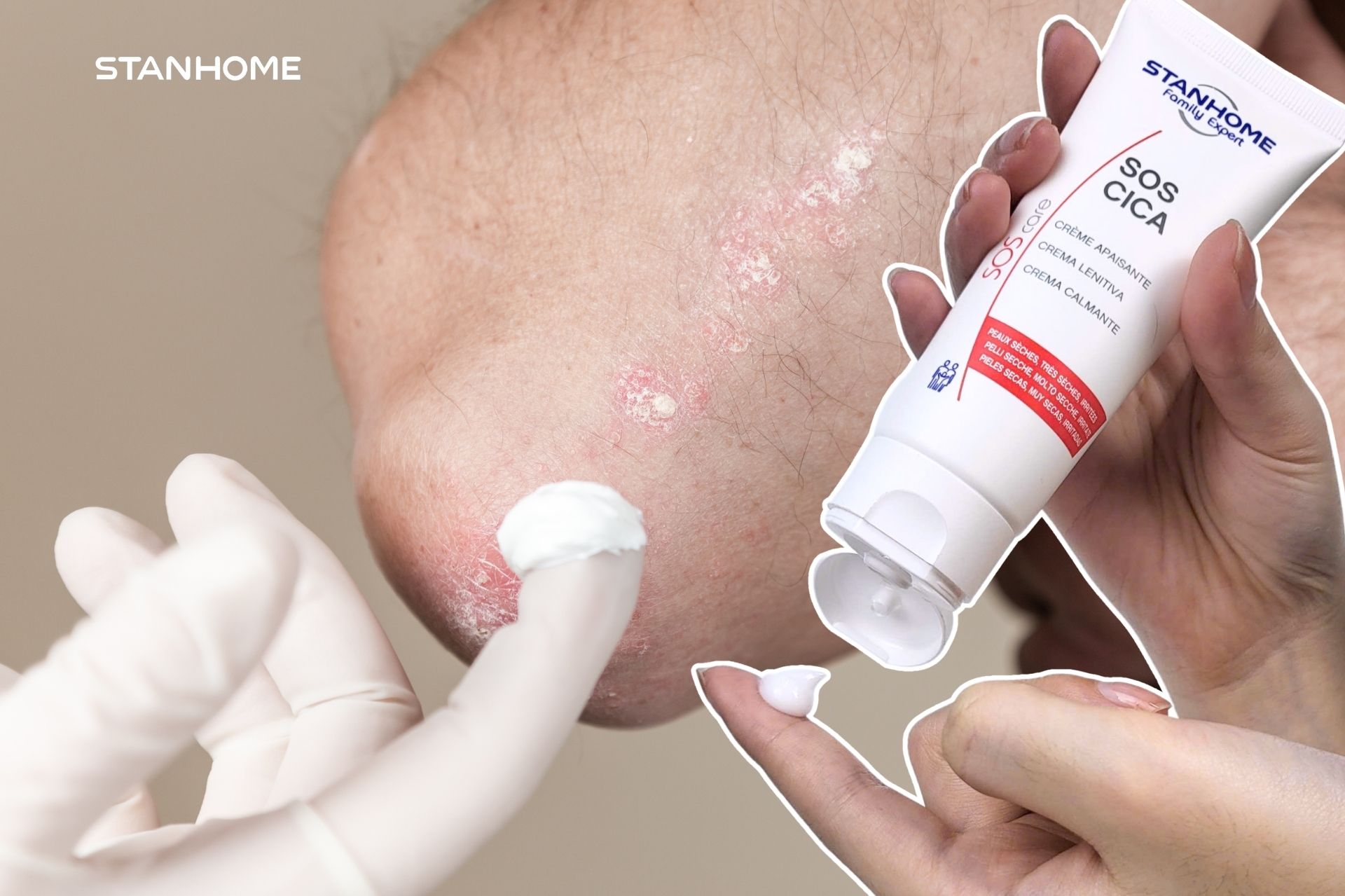 Cấp ẩm phục hồi là chìa khóa với vảy nến