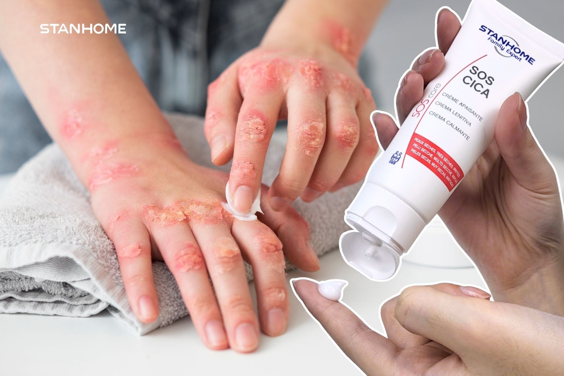 Cấp ẩm phục hồi là chìa khóa với vảy nến