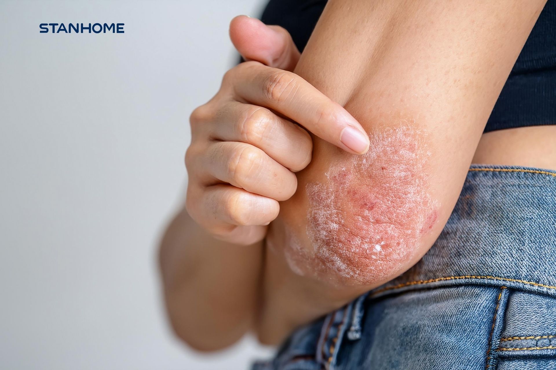 Nguyên nhân khiến bệnh vảy nến tái phát liên tục