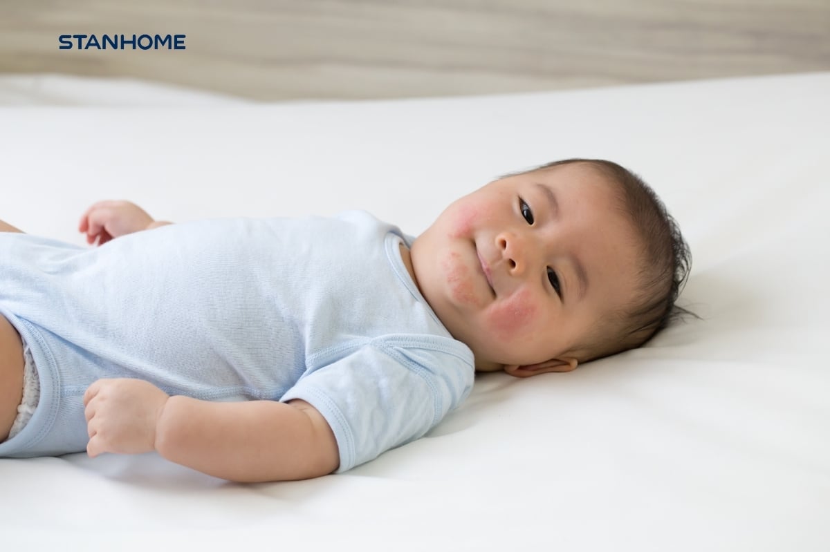 Viêm da cơ địa ở trẻ em, đặc biệt là viêm da cơ địa ở trẻ sơ sinh, là bệnh lý da liễu mãn tính, khiến trẻ thường xuyên gặp tình trạng ngứa ngáy, khô da và mẩn đỏ