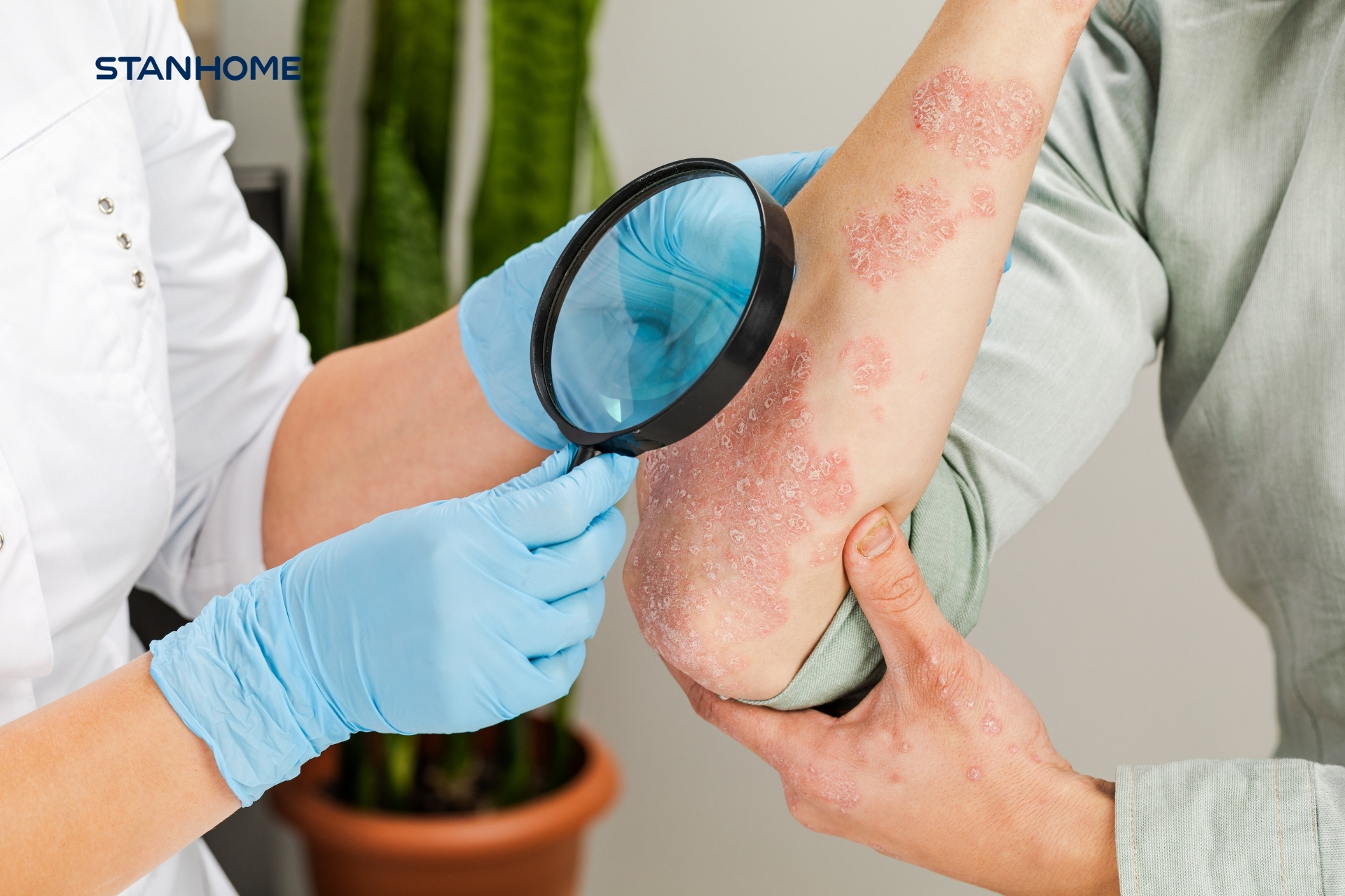 Bệnh vảy nến có chữa được không