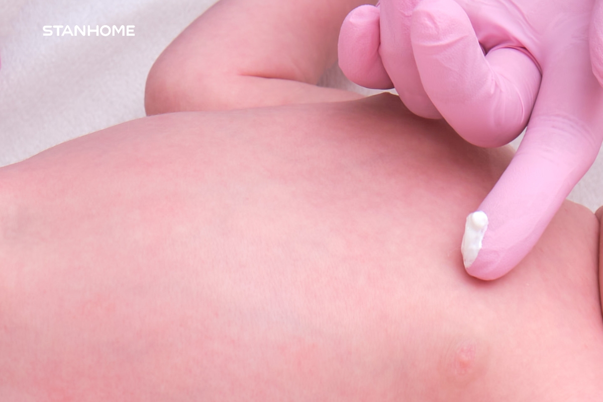 Thuốc bôi viêm da cơ địa trẻ em thường dạng kem và thuộc vào nhóm thuốc chứa corticoid