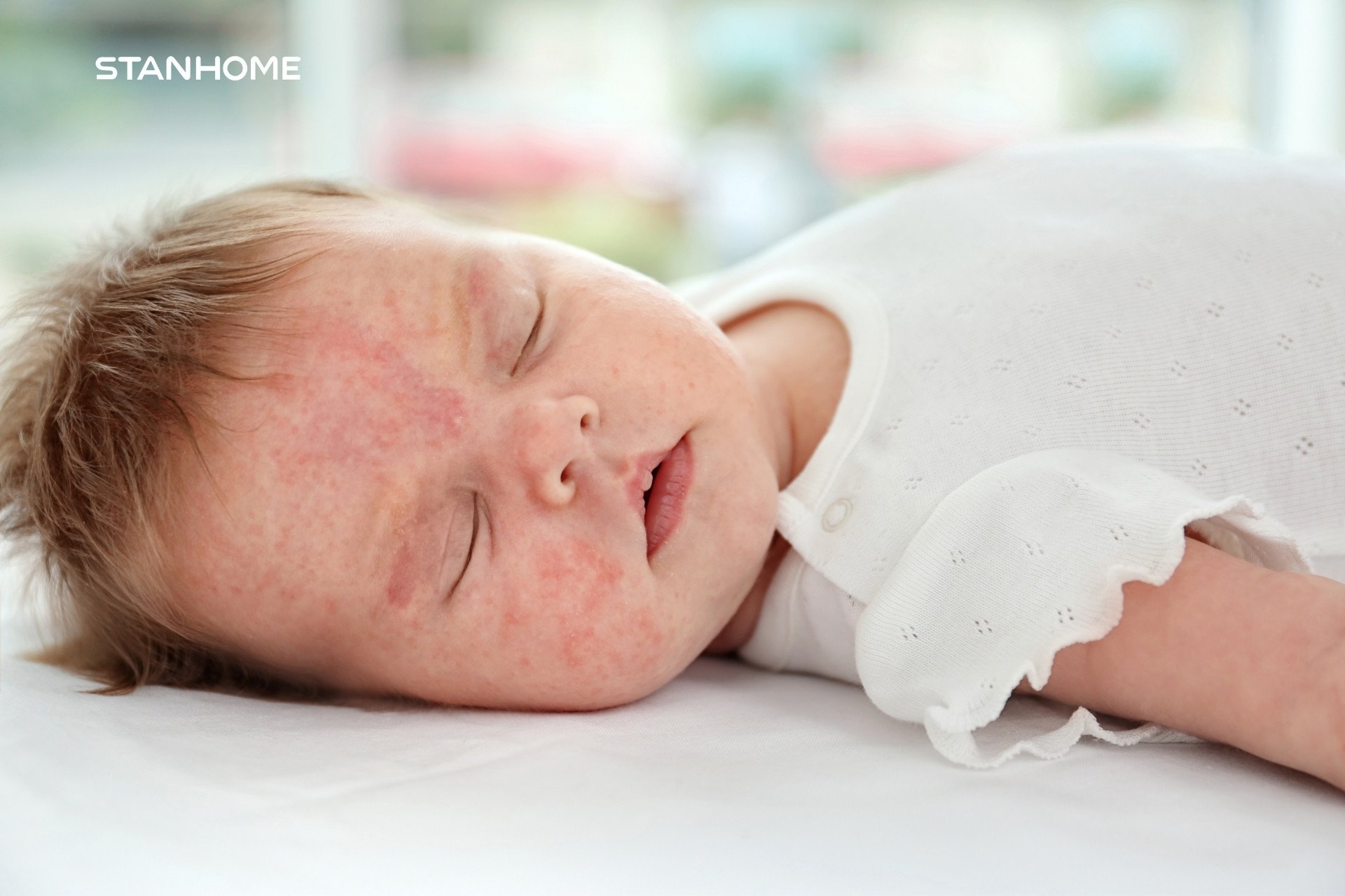 Chàm da ở trẻ em, đặc biệt là trẻ sơ sinh là hiện tượng khá phổ biến