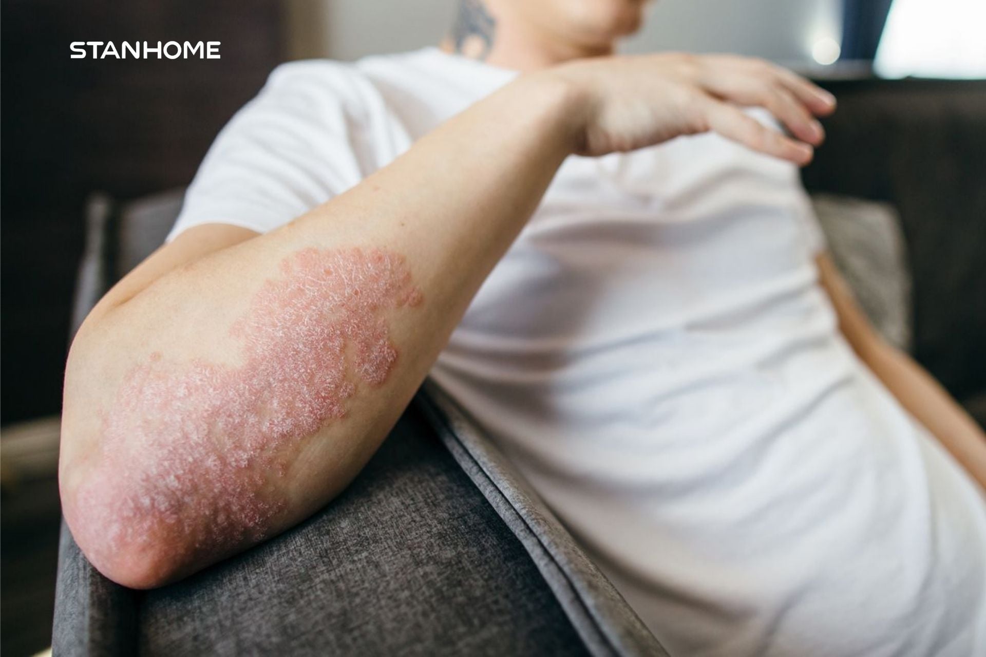 Chung sống hòa bình với bệnh vảy nến