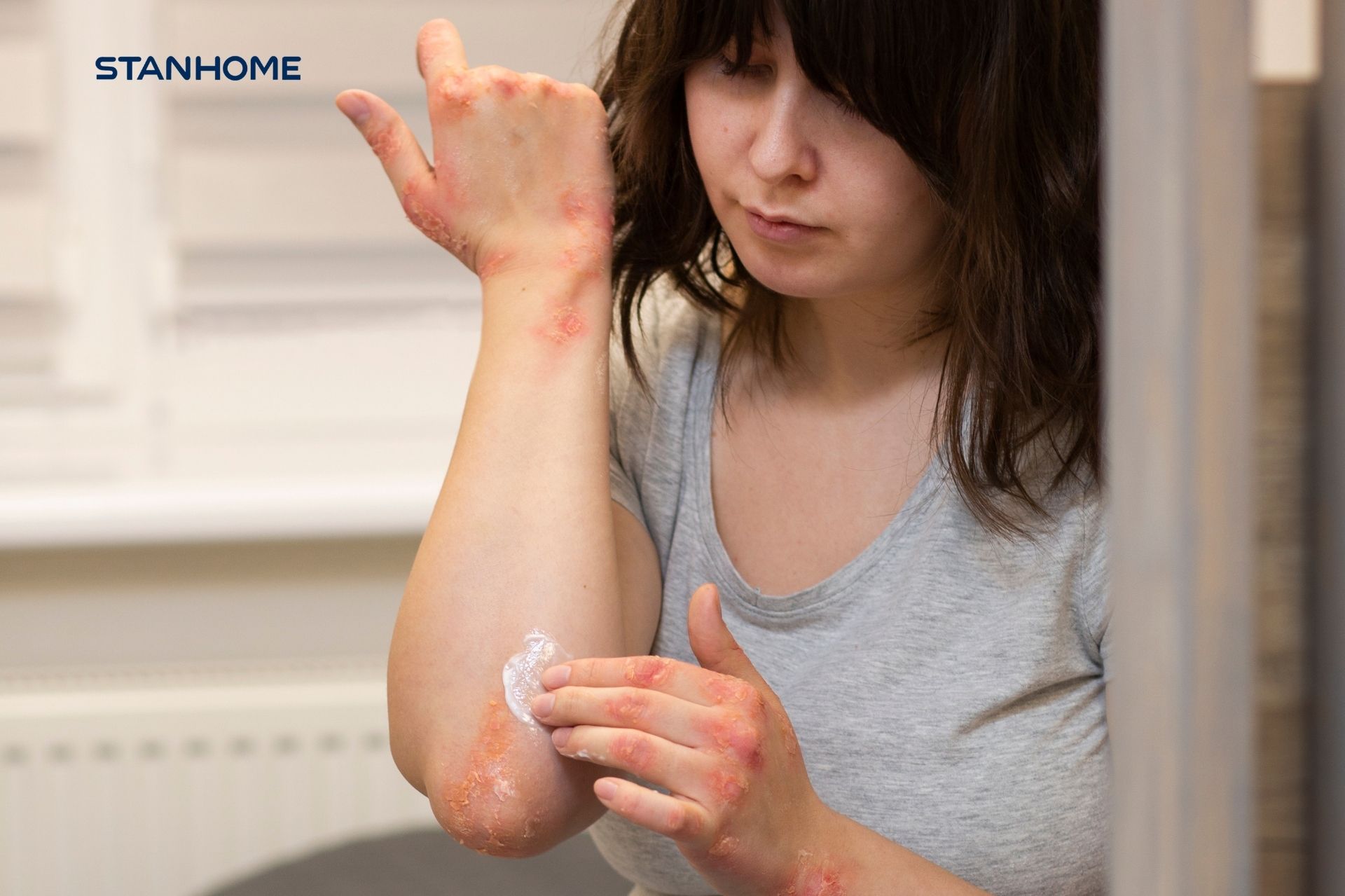 chăm sóc và điều trị vảy nến đúng cách