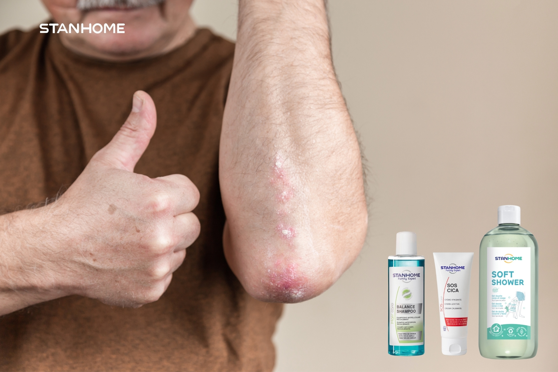 Cách chăm sóc vảy nến tại nhà bằng dược mỹ phẩm Stanhome