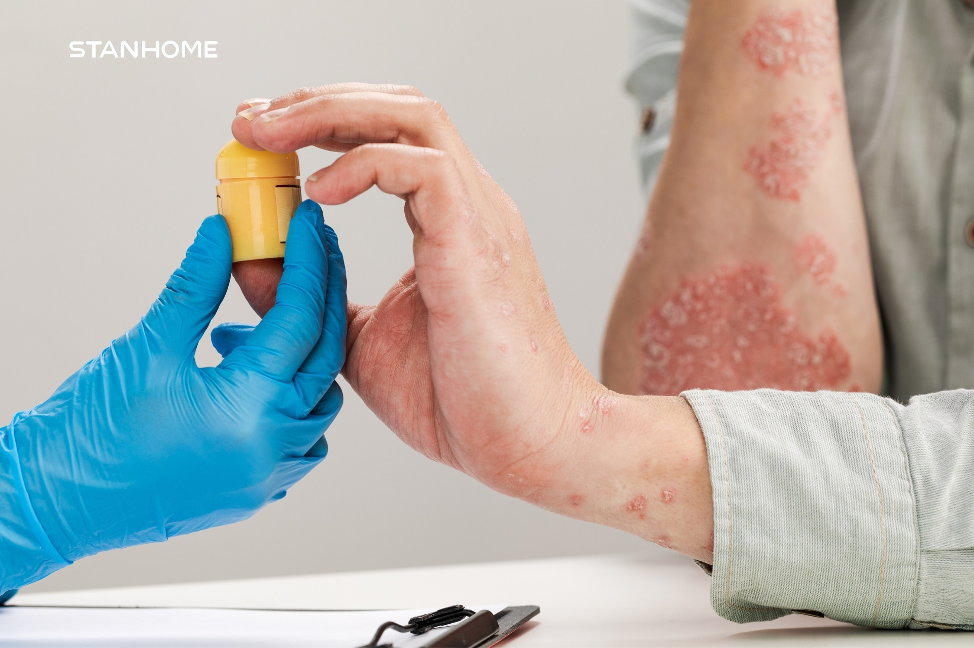 Các yếu tố gây khởi phát và làm bệnh tái phát bệnh vảy nến