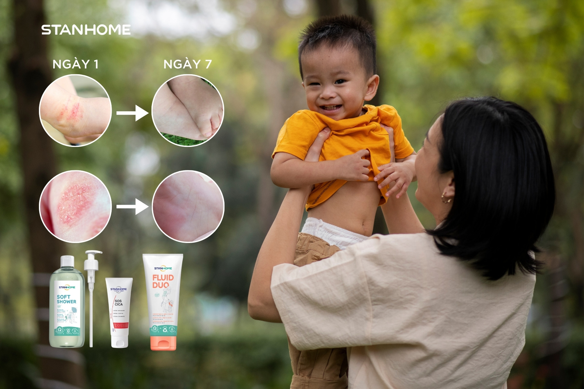 Thay đổi phương pháp chăm sóc hàng ngày giúp kiếm soát viêm da cơ địa cho trẻ hiệu quả