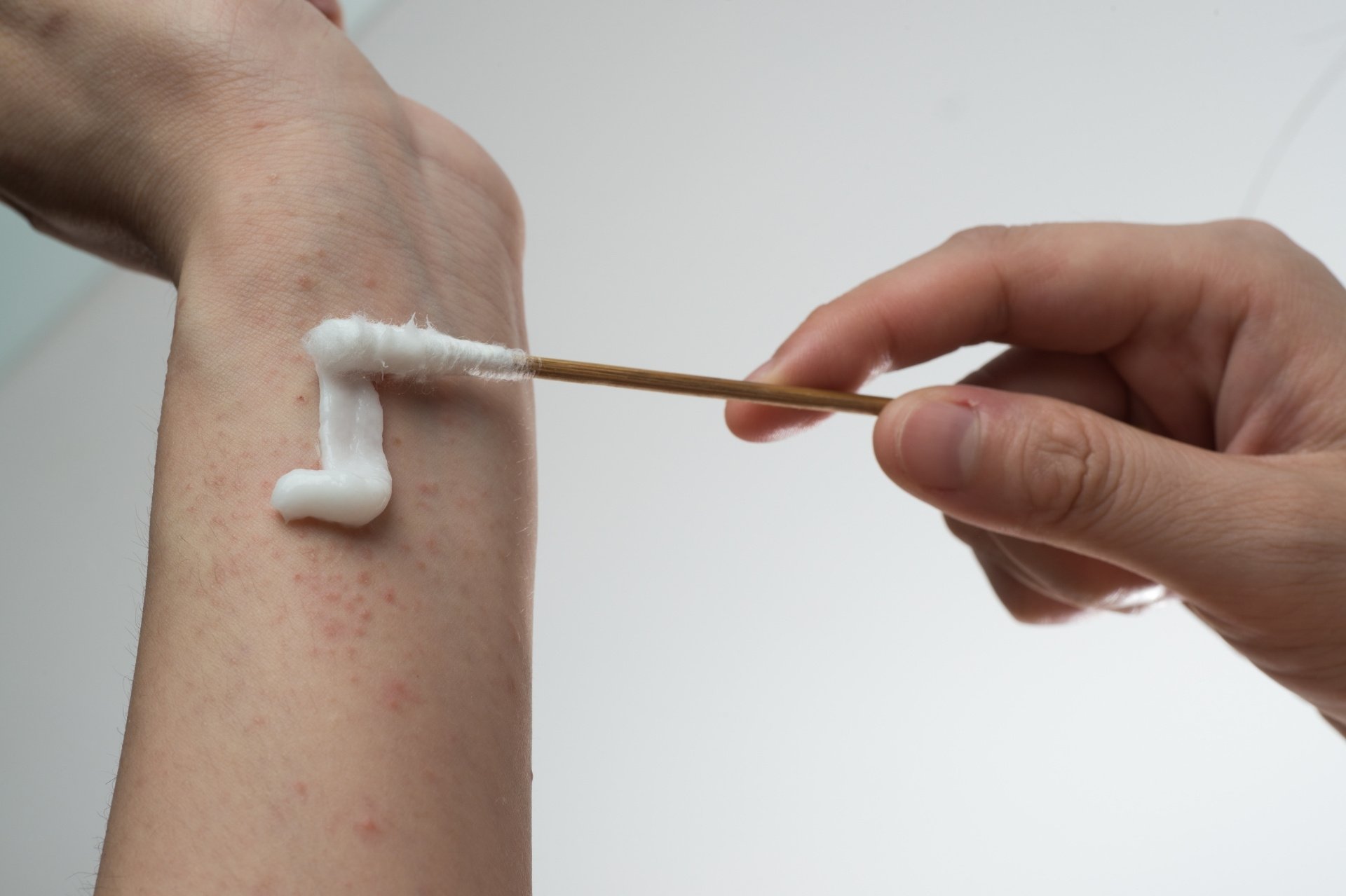 Kem bôi viêm da cơ địa không chứa corticoid có thể sử dụng hàng ngày để tăng cường hàng rào bảo vệ da