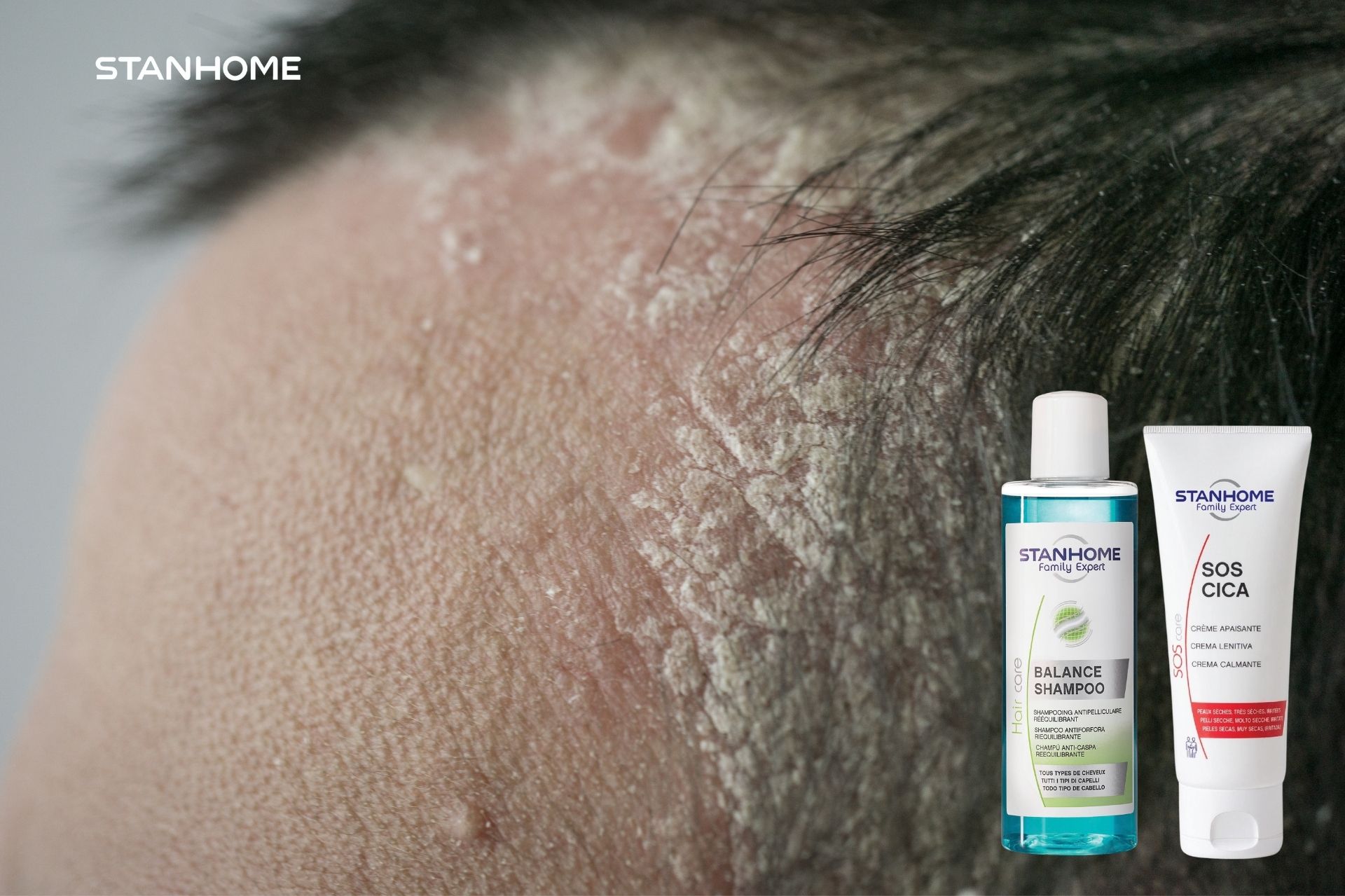 Làm sạch vảy nến da đầu tại nhà