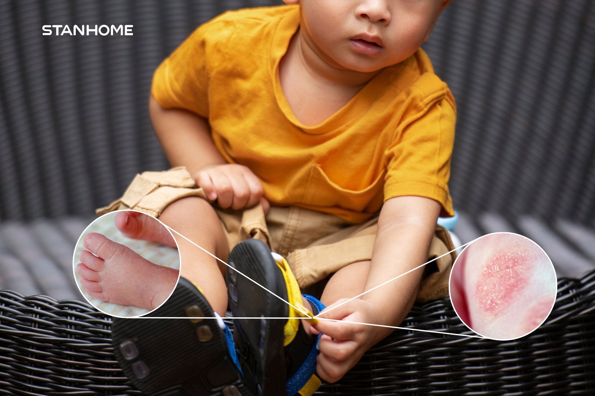 Viêm da cơ địa khiến bé không thể ngừng gãi ngứa, dẫn đến da bị tổn thương nghiêm trọng