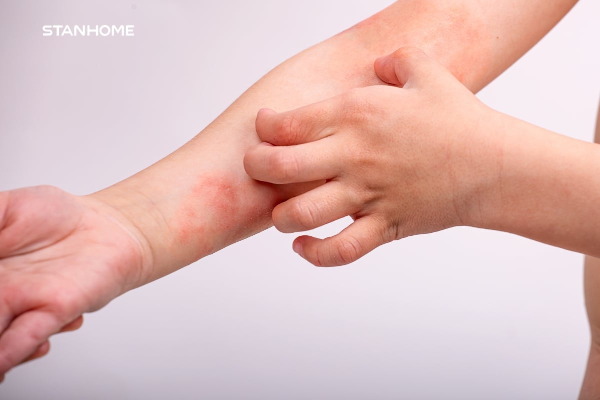 Trẻ bị viêm da cơ địa thường xuyên ngứa ở các vùng da bị đỏ, tạo thành những vết thương hở.