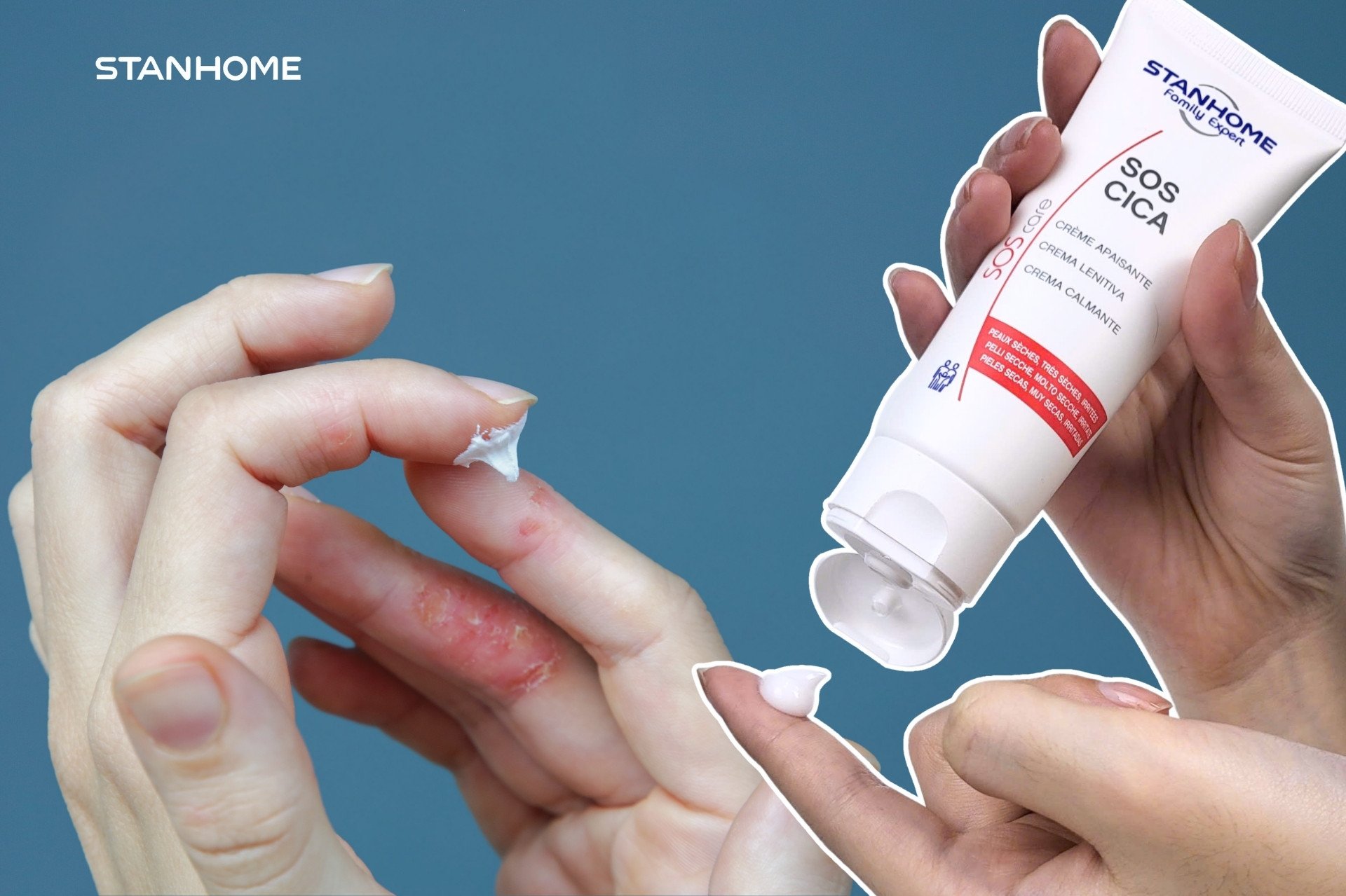 Sử dụng kem bôi phục hồi da không chứa corticoid giúp giảm ngứa và bong tróc da hiệu quả