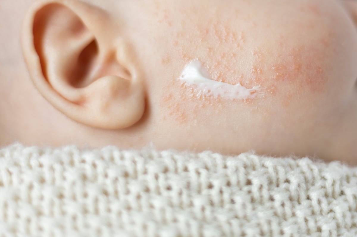 Thuốc bôi viêm da cơ địa trẻ em chứa corticoid cần sử dụng theo liều lượng chỉ định của bác sĩ da liễu