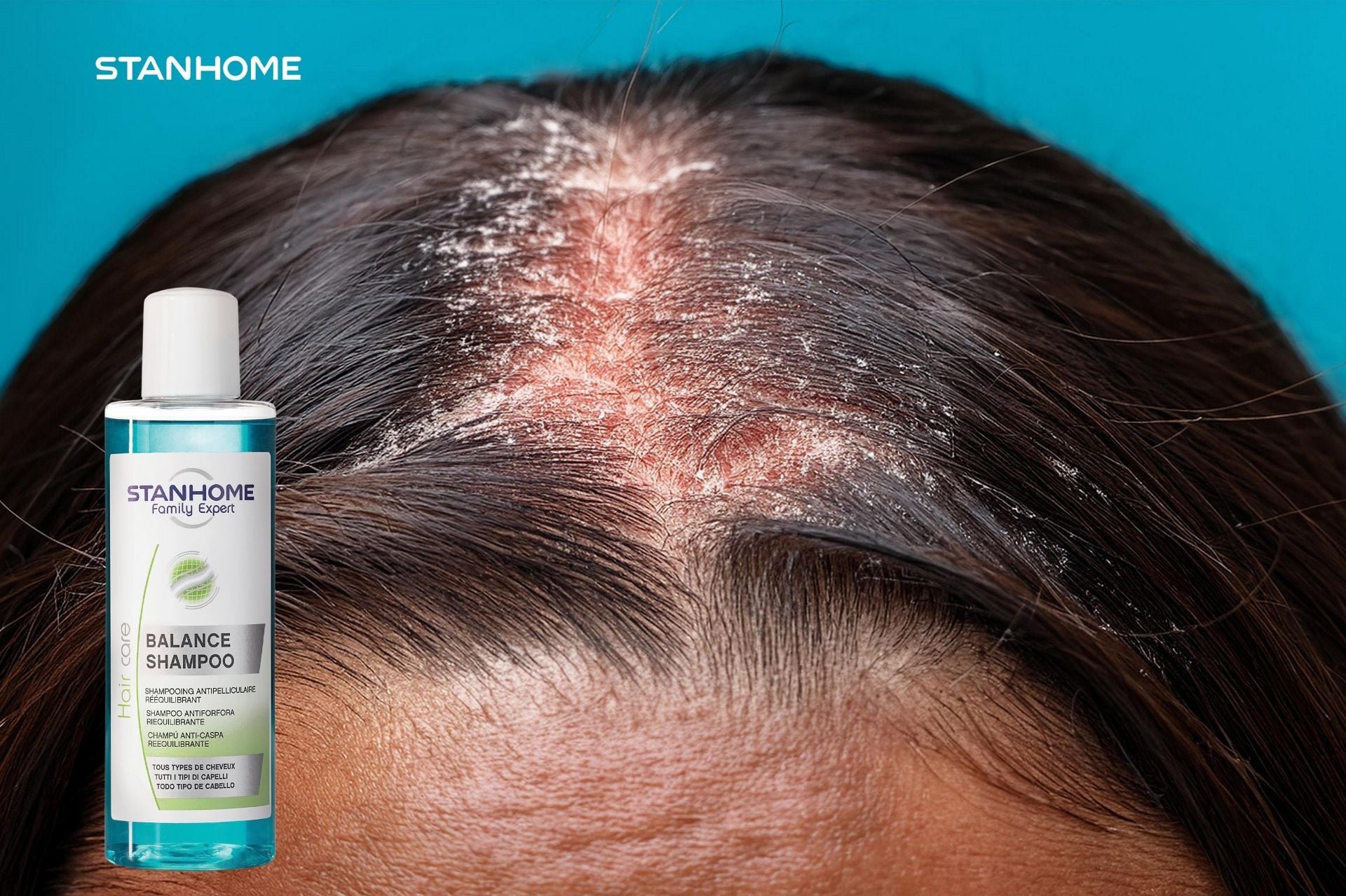 Làm sạch vảy nến da đầu tại nhà