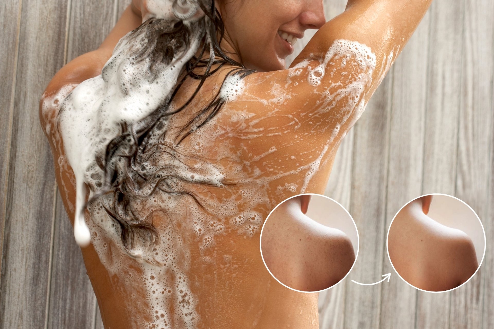 Sữa tắm trị mụn lưng mụn ngực Stanhome All in One Shower được lựa chọn để điều trị và ngăn ngừa mụn cơ thể, da mặt