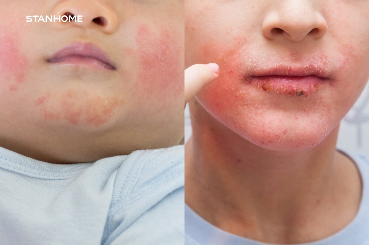 Viêm da cơ địa ở trẻ em thường xuất hiện ở gia đoạn sớm và kéo dài đến tuổi dậy thì nếu không chăm sóc phù hợp