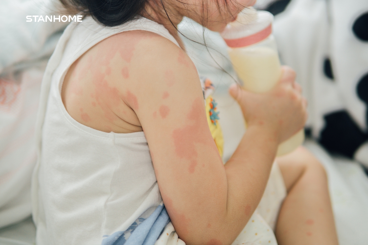 Triệu chứng viêm da cơ địa ở trẻ em cha mẹ cần lưu ý