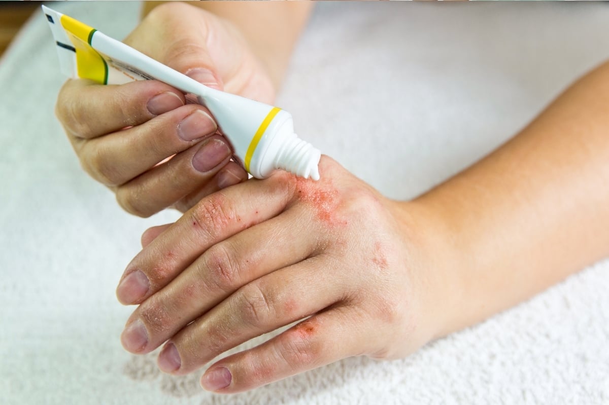 Sử dụng thuốc bôi viêm da cơ địa chứa corticoid để giảm viêm ngứa dưới sự hướng dẫn của bác sĩ da liễu